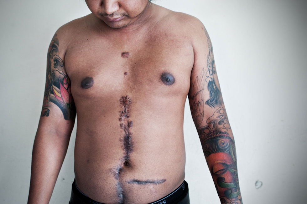 Bunthoeun Kann, 29, aka T-Money, who was born in a refugee camp, shows his gunshot wounds from a Cambodian gang member who fired. (Pete Pin)
