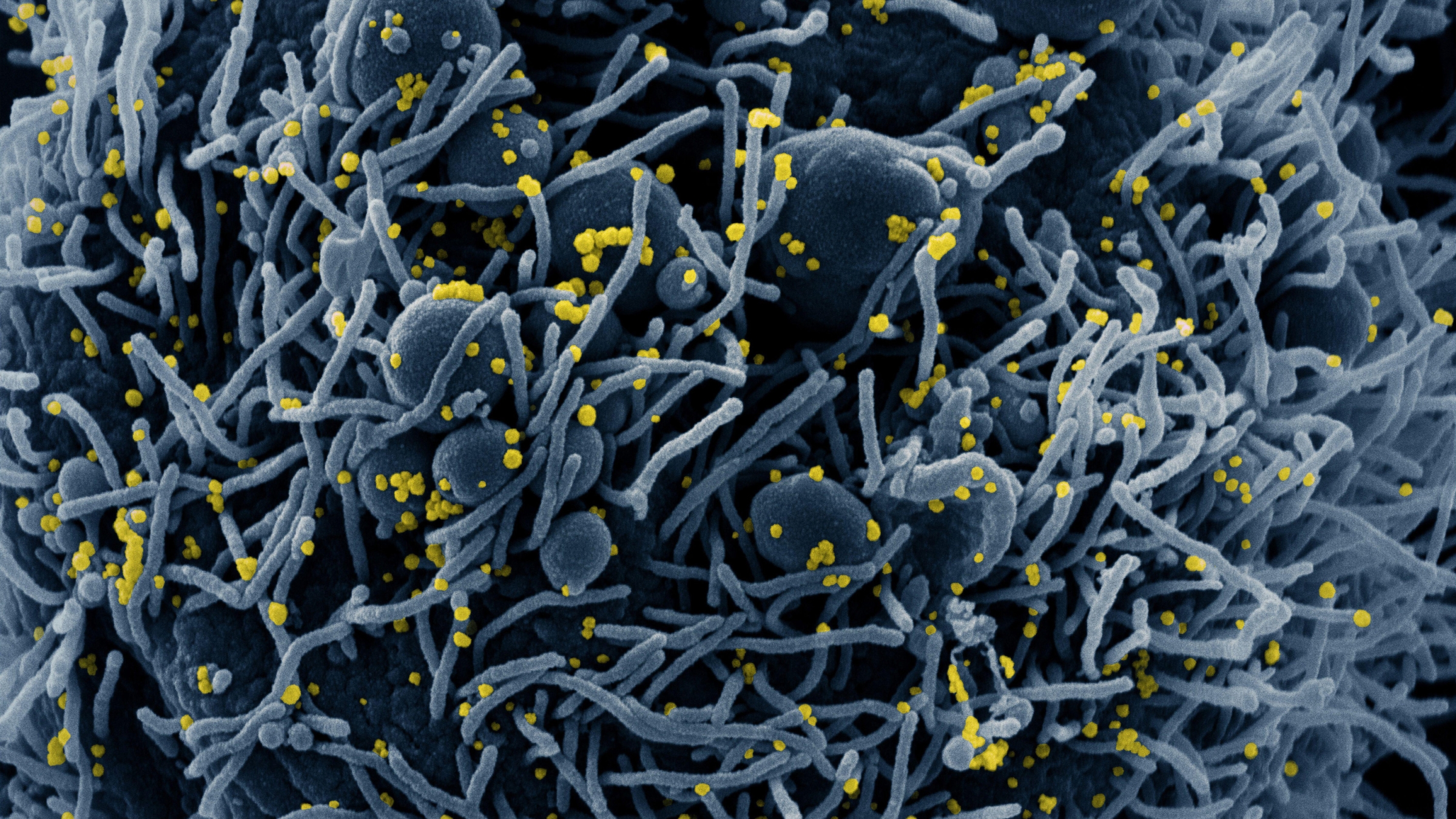 Novel Coronavirus SARS-CoV-2 colorized scanning electron micrograph of an apoptotic cell (blue) infected with SARS-CoV-2 virus particles (yellow), isolated from a patient sample. Phanie / Alamy